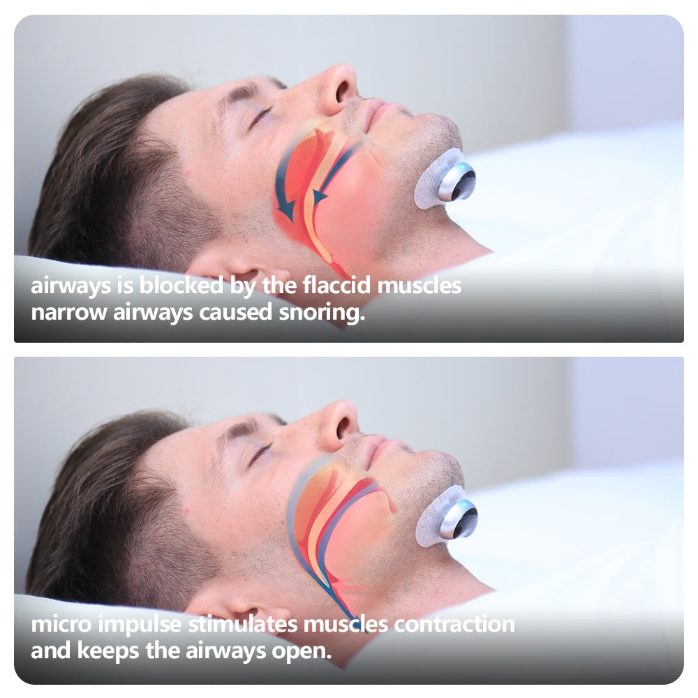 Smart Anti Snoring Device – Electronic Muscle Stimulator